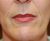 Feel Beautiful - Lip Creases Lip Lines and Slight Lip Augmentation - Before Photo